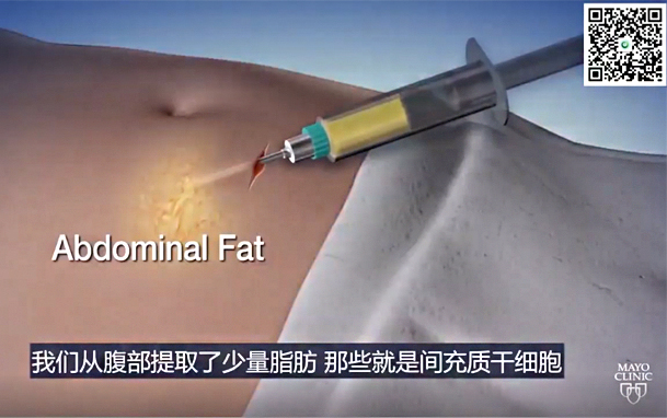 干細(xì)胞醫(yī)療——他靠脂肪治好了高位截癱
